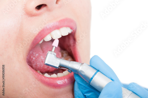 Dentist ussing pink polishing stone to remove plaque from teeth