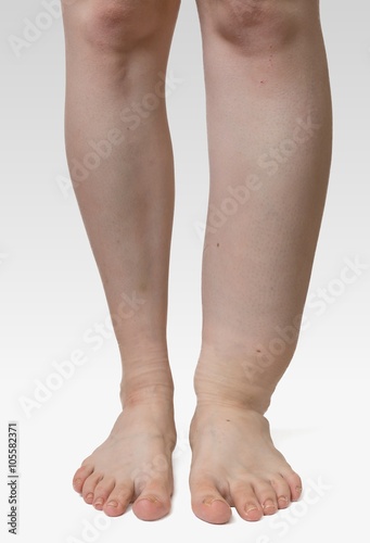 Leg of diseased patient who suffers from Edema.