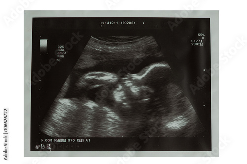 Ultrasound picture of baby