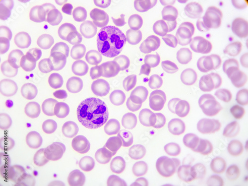 Neutrophil cell (white blood cell) in peripheral blood smear 