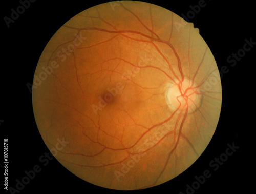 Human eye anatomy, retina, optic disc artery and vein etc. takin