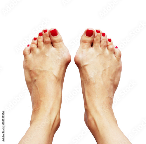 Valgus deformity of legs due of the cross flatfoot (hallux valgus).