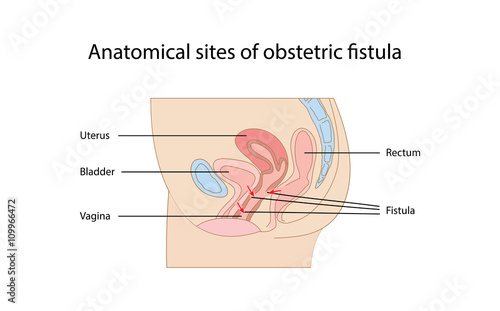 Anatomical sites of obstetric fistula diagram