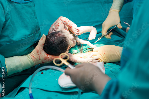 Real operation for cesarean section with new born infant in operating theater.