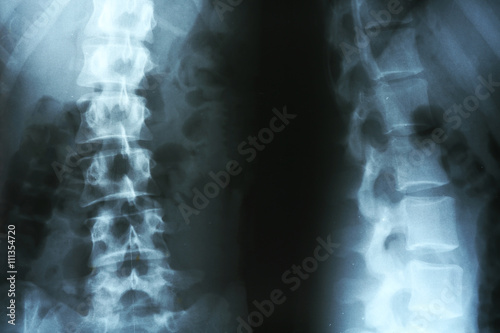 X-ray of human spinal column closeup