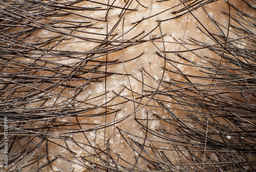 Dandruff on scalp and dark hair. Macro shot