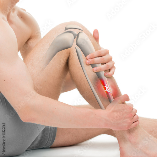 Comminuted Fracture of the Tibia - Leg Fracture 3D illustration