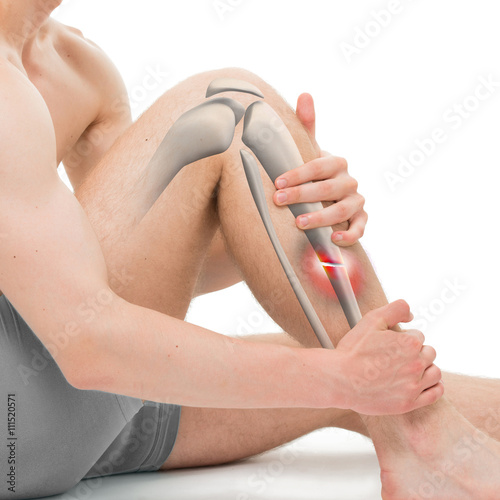 Transverse Fracture of the Tibia - Leg Fracture 3D illustration