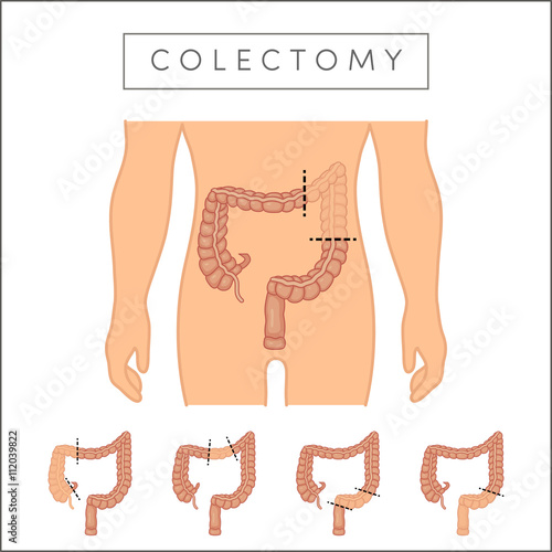 Types of colectomy