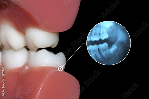 dental diagnosis xrays teeth toothache graphic