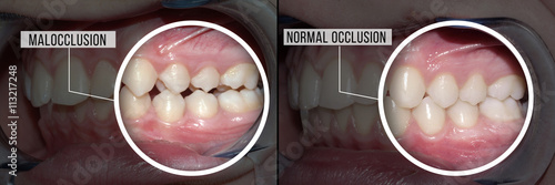 dental treatment malocclusion: before and after