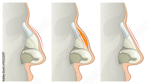 Nose surgery