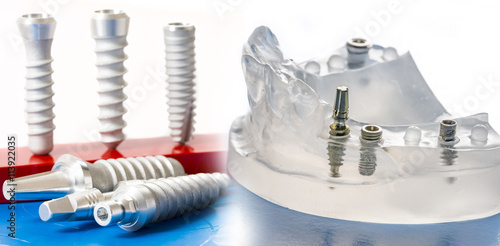 dental implants in dental model