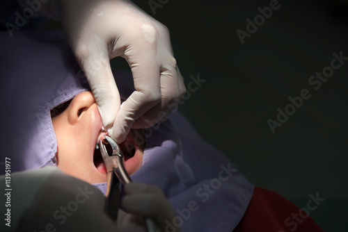 Caries tooth extraction by the dentist. Dentistry in hospital 