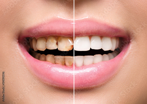 Woman's teeth before and after whitening. Oral care