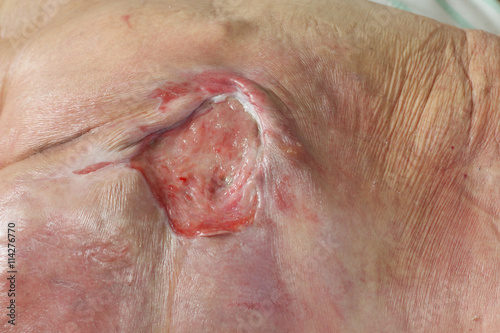 ulcer on the sacrum - bedsore II degree. Pressure Ulcers