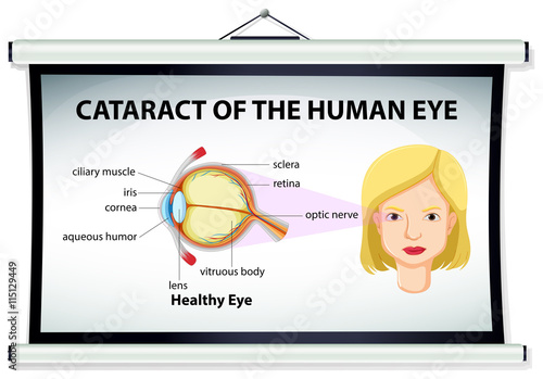 Diagram of cataract in human eye