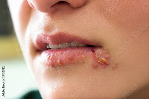 Herpes blisters