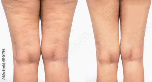 Cellulite women. Figure of a young girl before and after.