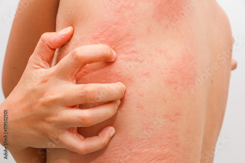 Women with symptoms of itchy urticaria.