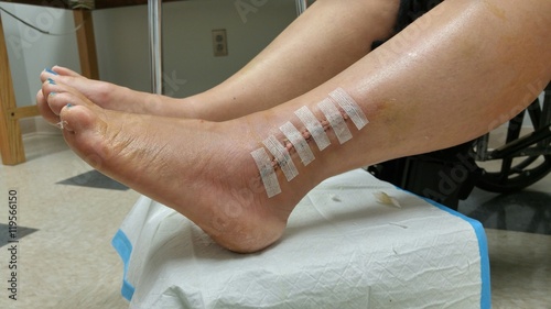 Woman's leg with post op surgical site open with strip style bandages