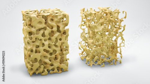 Bone structure 3d illustration, normal and with osteoporosis