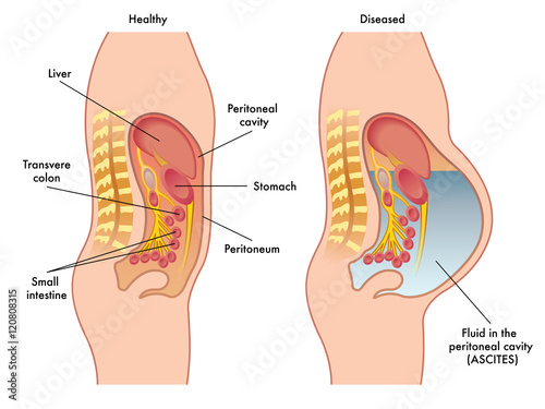 ascites