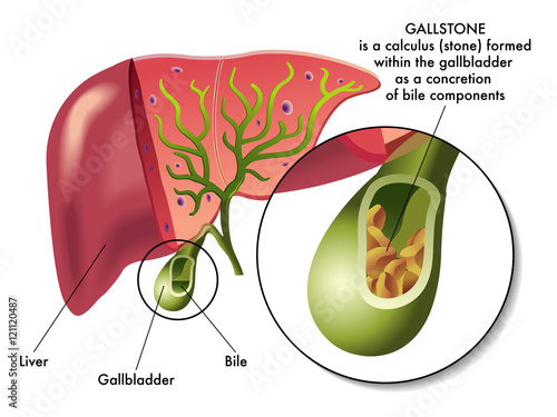 gallstones