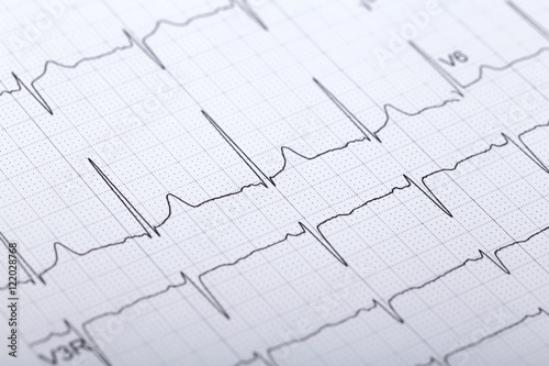 electrocardiogram