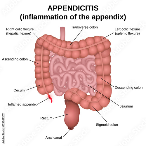 inflammation of the appendix