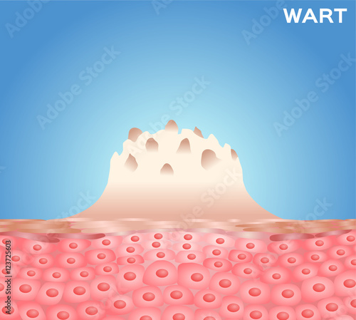 Wart on a person's hand close up , wart vector