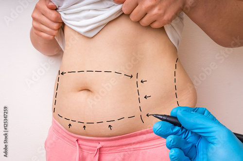 Plastic surgery doctor draw lines with marker on patient belly