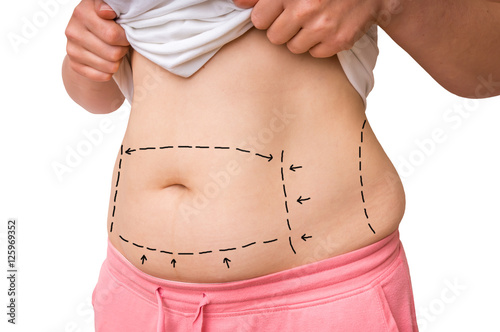 Plastic surgery doctor draw lines with marker on patient belly