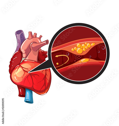 Myocardial infarction vector