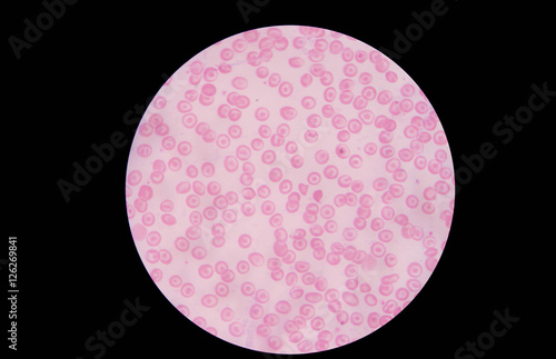 in Slide blood smear show target cell for complete blood count in microscope