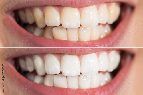 Osoba Zęby przed i po wybielaniu