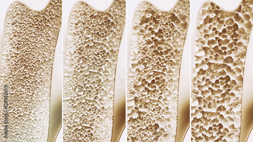 Osteoporosis 4 stages - 3d rendering