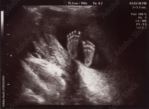 Ultrasound of In Uterus Baby at 22 weeks. Healthy baby in belly.