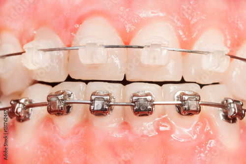 Tooth alignments with ceramic and metal braces