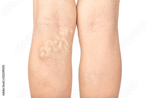 Varicose veins in the legs