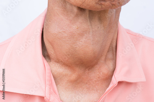Woman with enlarged hyperthyroid gland. Hyperthyroidism symbol.