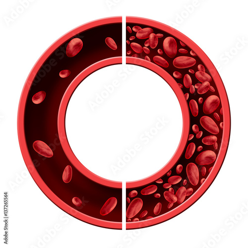 Anemia Anaemia Concept Diagram