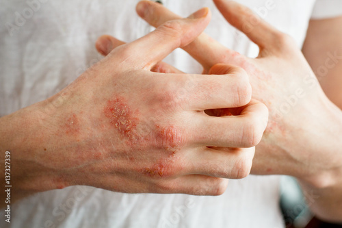 The problem with many people - eczema on hand. White background. Man itchind skin.