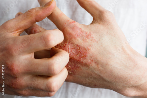 The problem with many people - eczema on hand. White background. Man itchind skin.