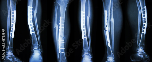 Collection image of leg fracture and surgical treatment by internal fixation with plate and screw . Break tibia and fibula bone .