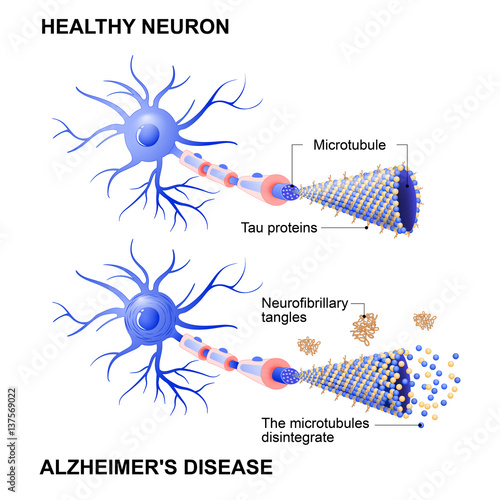 healthy cell and neurons with Alzheimer's disease. Tau hypothesis