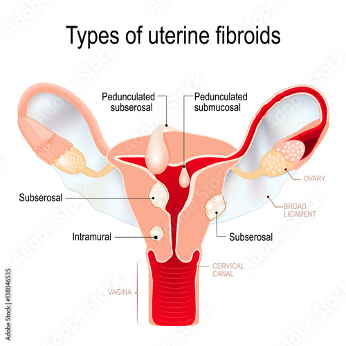 types of uterine fibroids: subserosal, intramural, submucosal, and pedunculated fibroids.