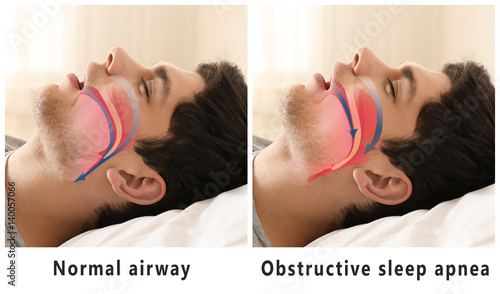 Snore problem concept. Illustration of normal airway and obstructive sleep apnea