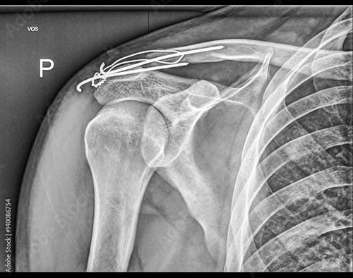 Broken clavicle bone fixation, Fracture repair