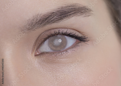 Eye of a woman with cataract and corneal opacity